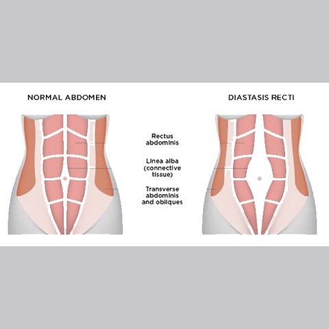 What can I do about abdominal separation postpartum? - Sydney Women's ...
