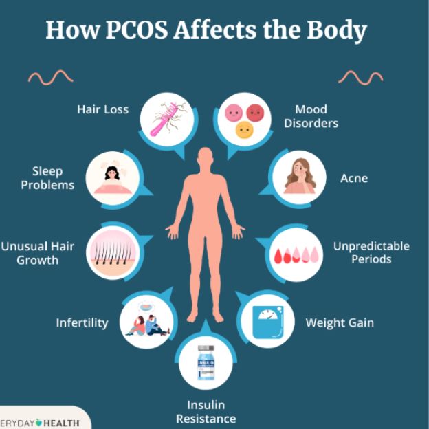 Polycystic ovary syndrome (PCOS)