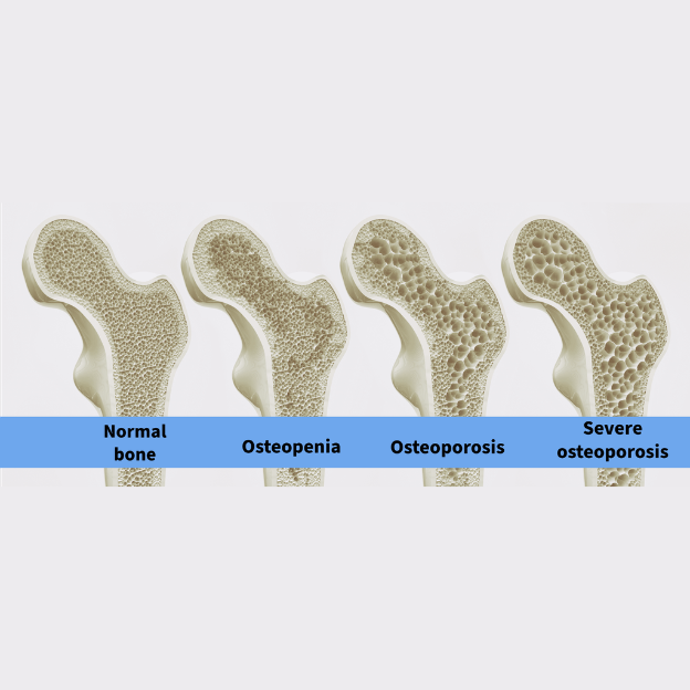 What is Osteoporosis & Osteopenia? 